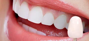 Dr. Joseph S. Levy - Porcelain Veneers