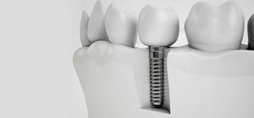 Dental Implants
