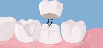 Dr. Joseph S. Levy - All Porcelain Crowns