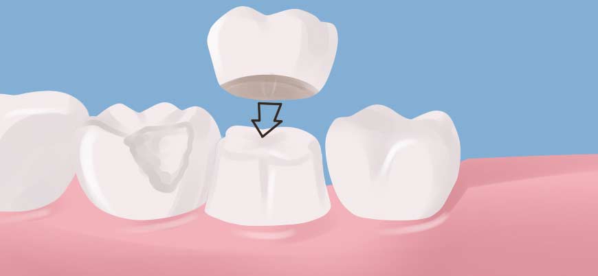 Dr. Joseph S. Levy: All Porcelain Crowns